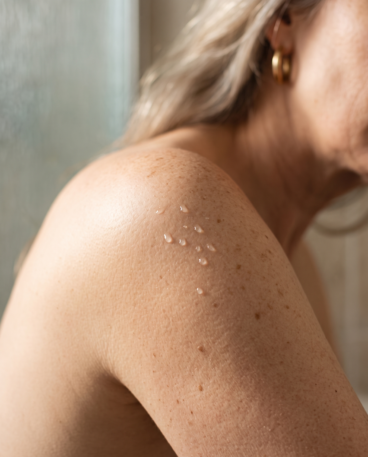 Eczema